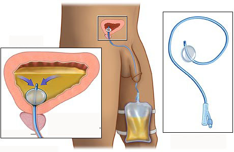 prostatitis y torunda uretral